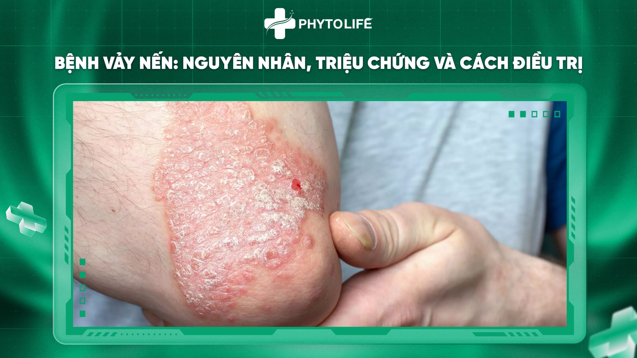 Bệnh vảy nến: Nguyên nhân, triệu chứng và cách điều trị hiệu quả