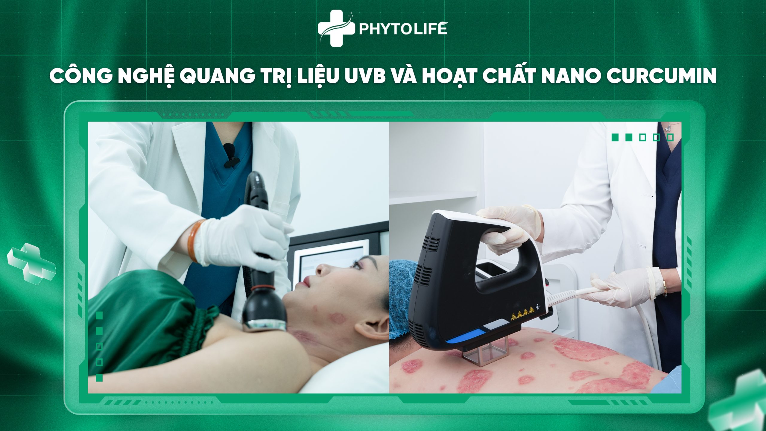 Công nghệ quang trị liệu UVB và Nano Curcumin