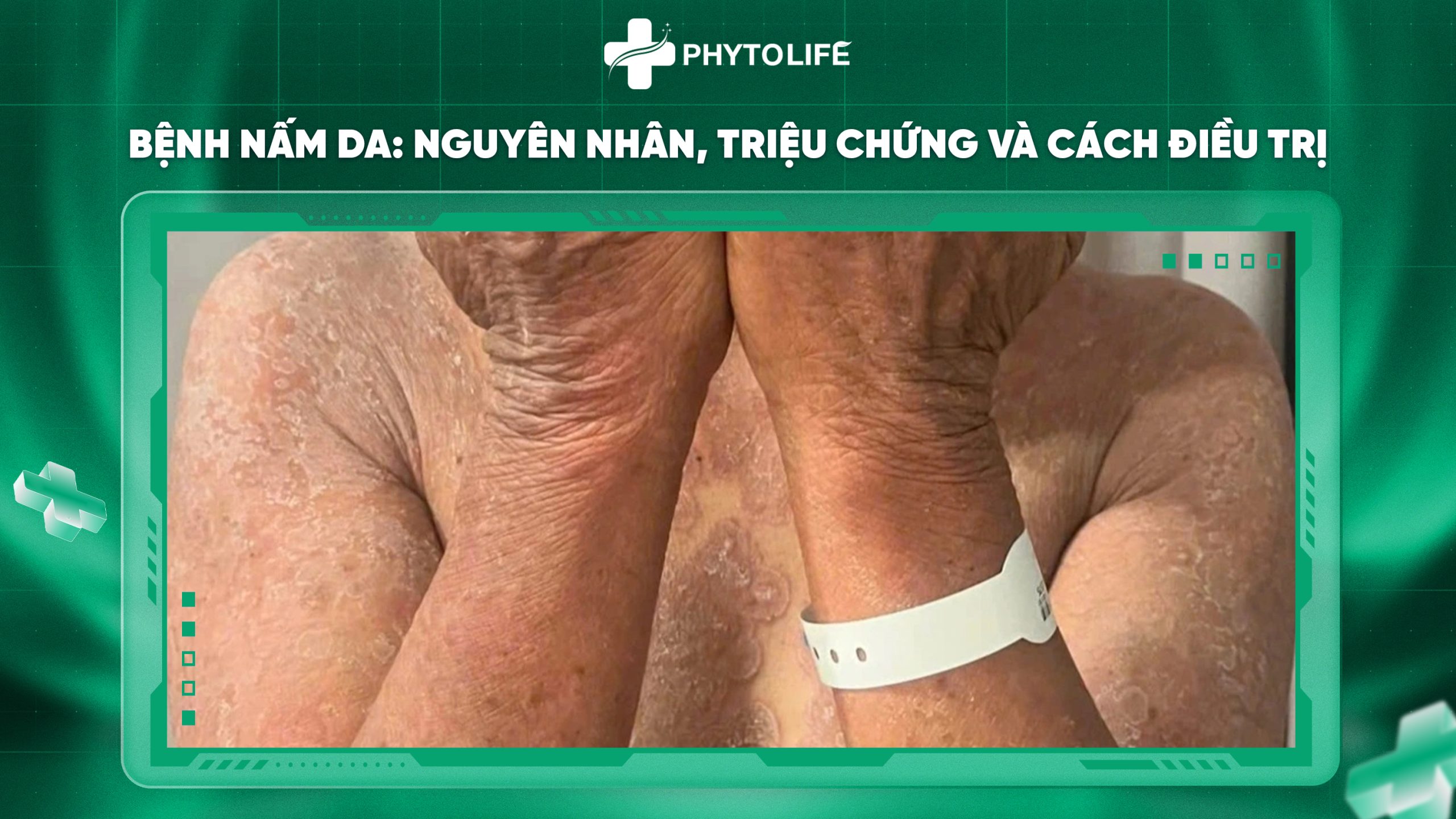Bệnh nấm da: Nguyên nhân, triệu chứng và cách điều trị hiệu quả