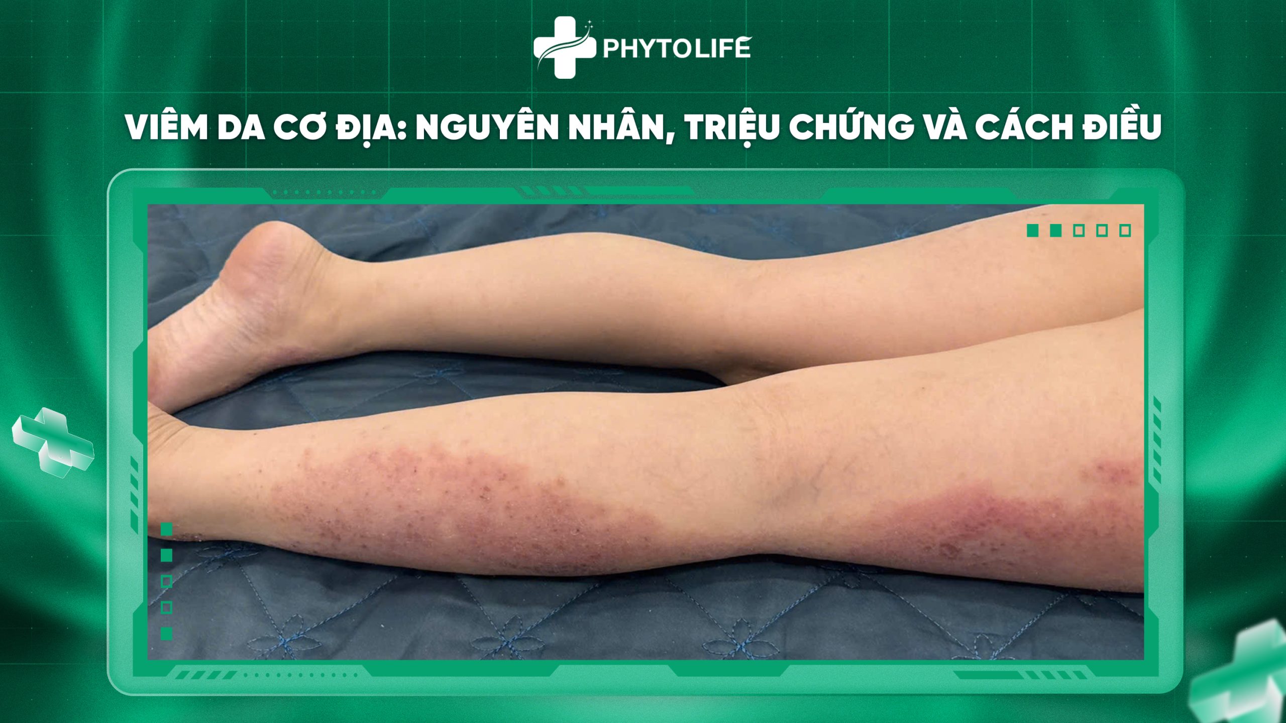 Viêm da cơ địa: Nguyên nhân, triệu chứng và cách điều trị hiệu quả