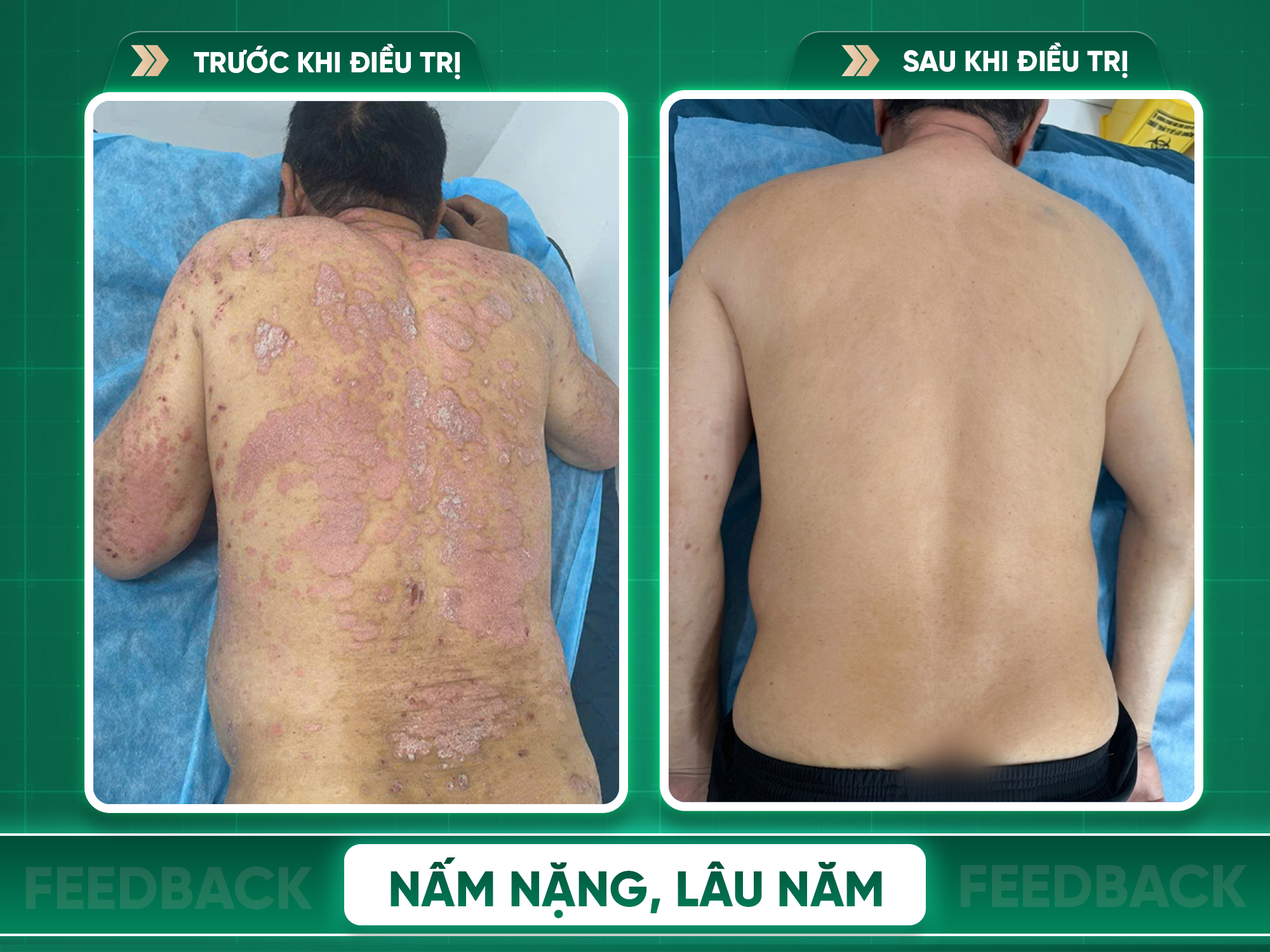 Kết quả trước và sau điều trị vảy nến