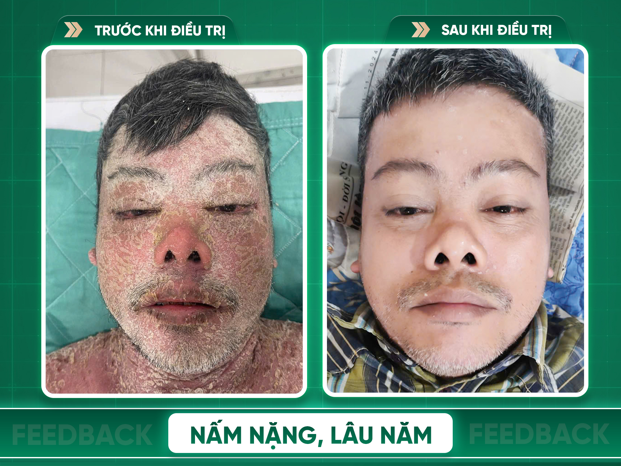 Kết quả trước và sau điều trị vảy nến
