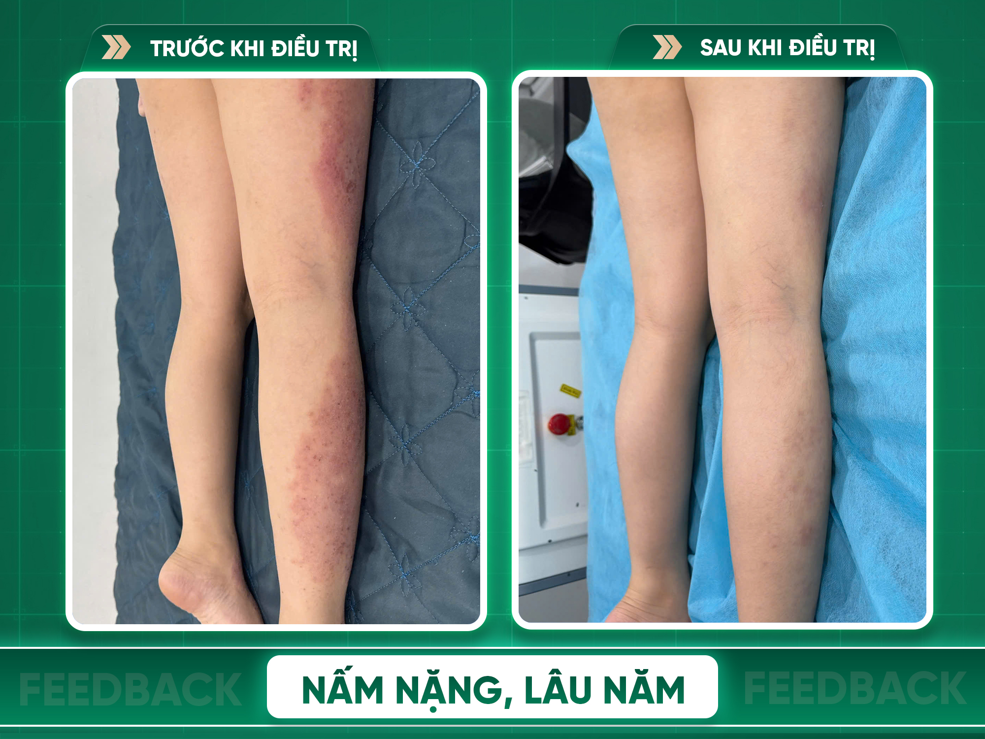 Kết quả trước và sau điều trị viêm da cơ địa