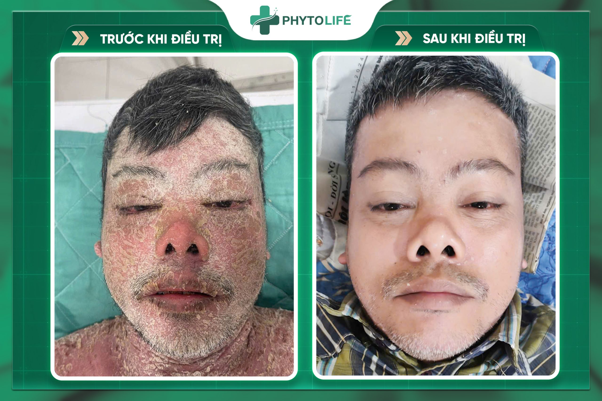 Hình ảnh trước và sau điều trị tại Phytolife 1