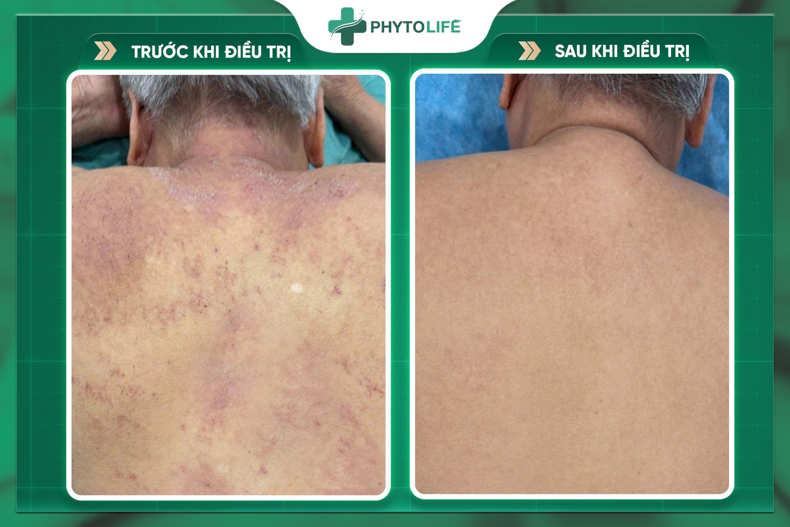 Hình ảnh trước và sau điều trị tại Phytolife 2