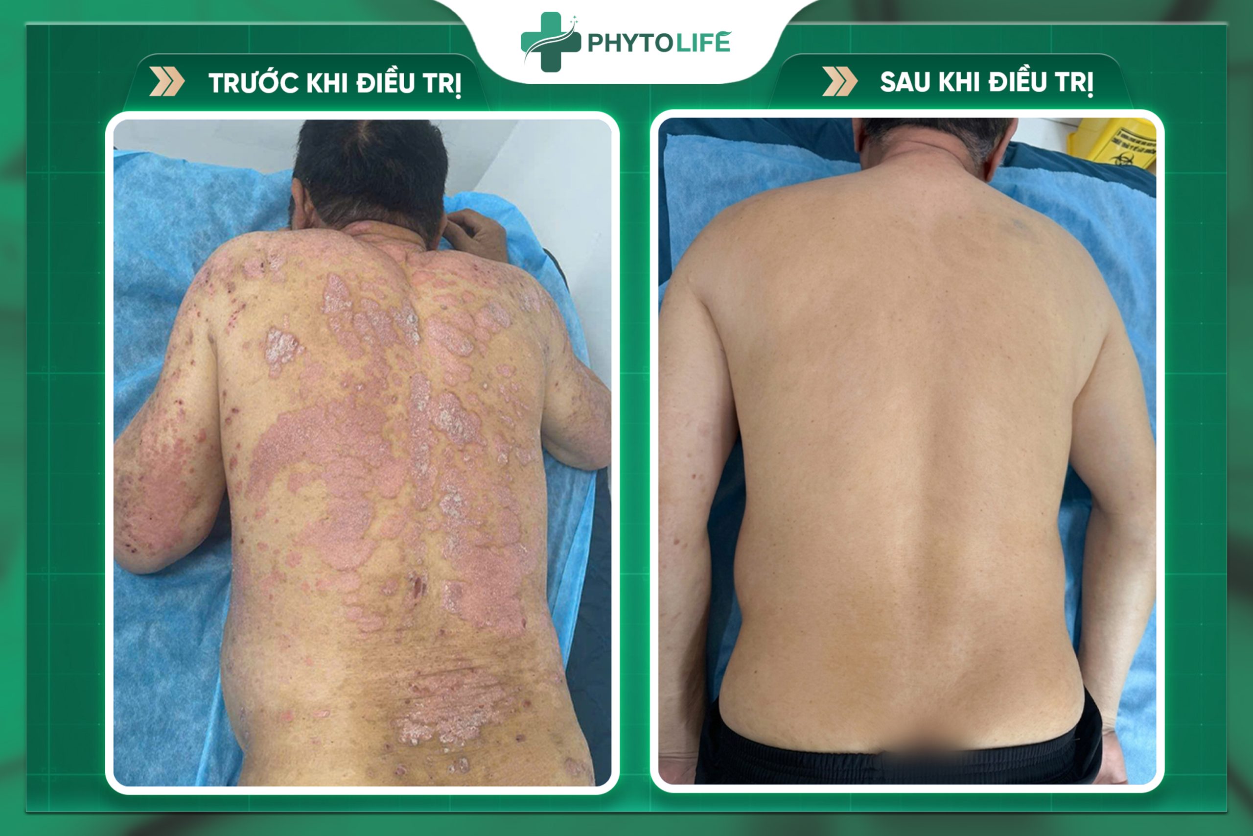 Hình ảnh trước và sau điều trị tại Phytolife 3