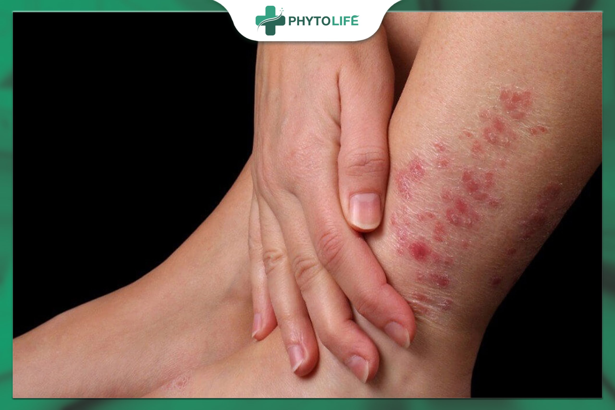 Nguyên nhân và con đường lây nhiễm