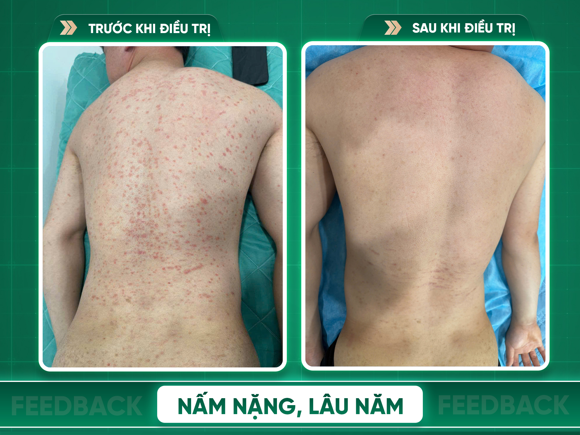 Kết quả trước và sau điều trị viêm da cơ địa