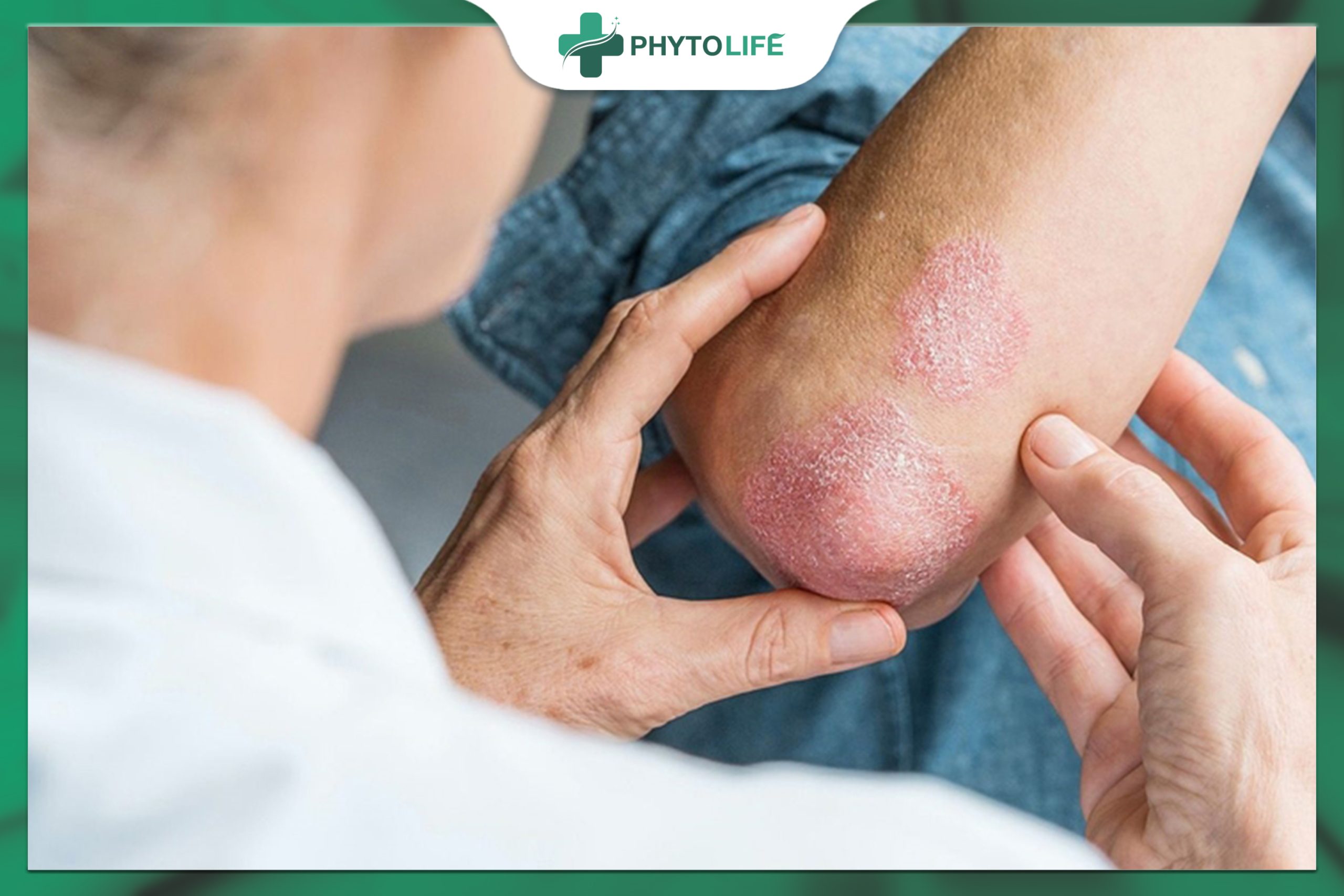 Chẩn đoán bệnh nấm da
