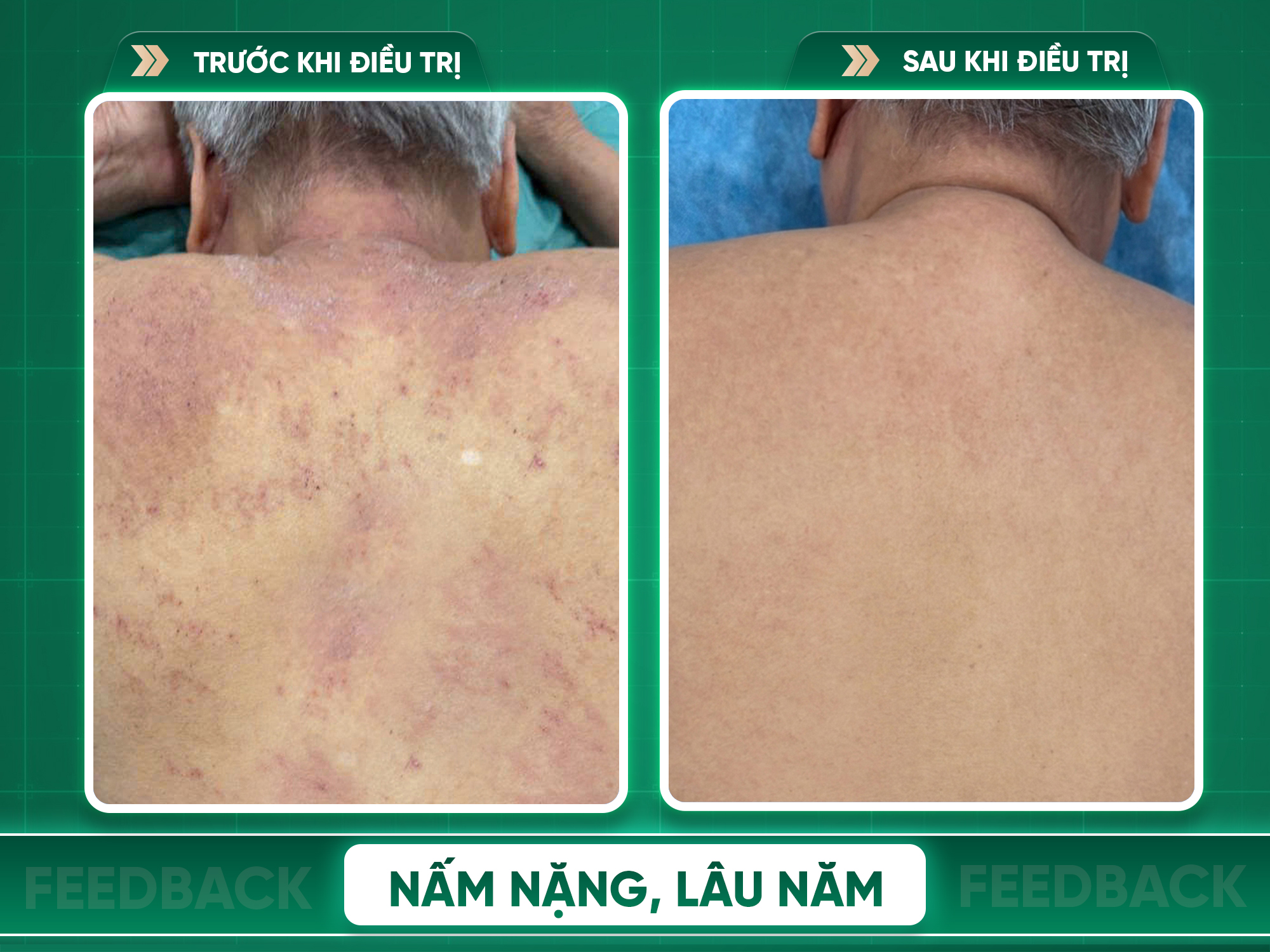 Kết quả trước và sau điều trị nấm da