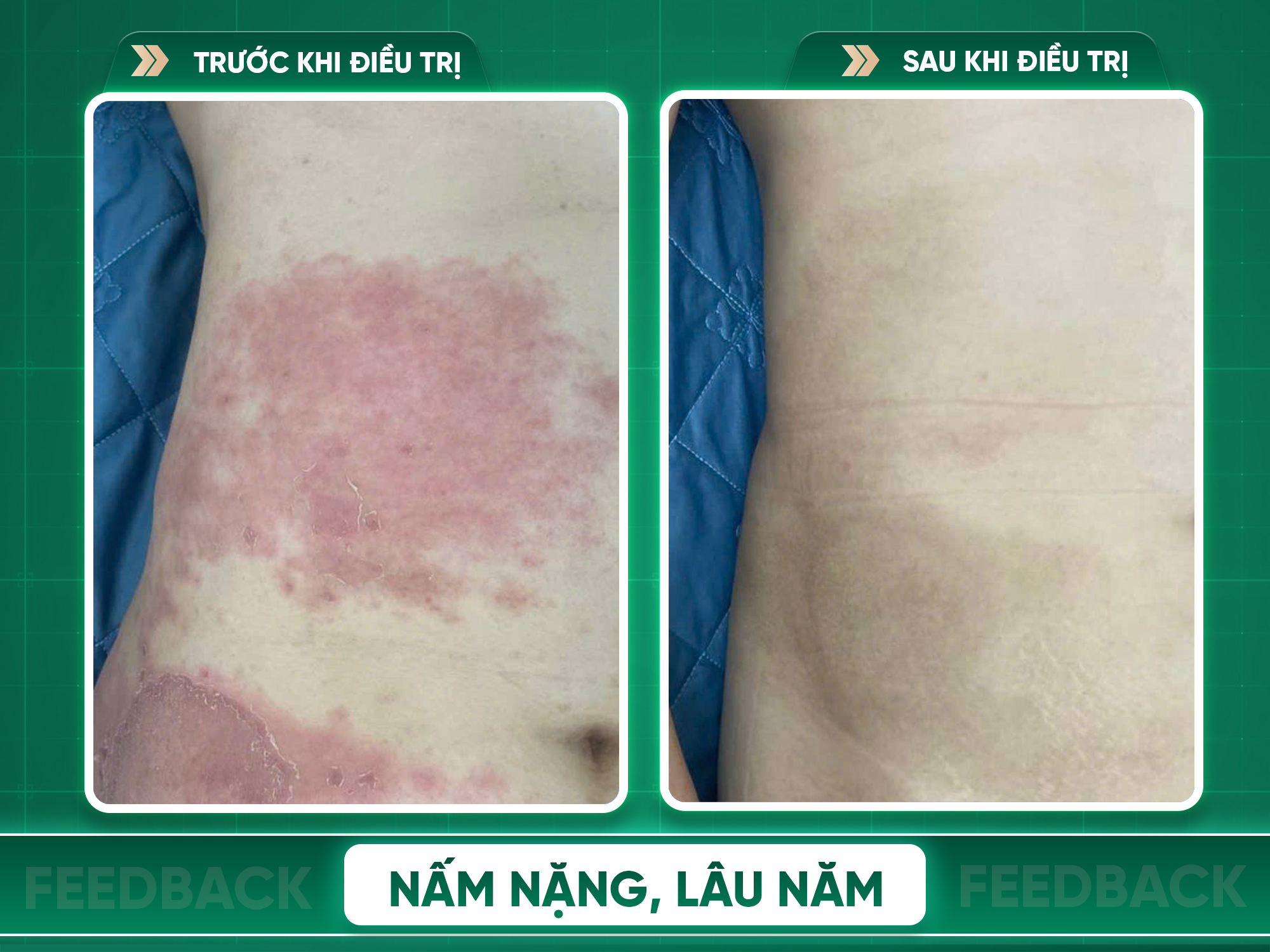 Kết quả trước và sau điều trị nấm da