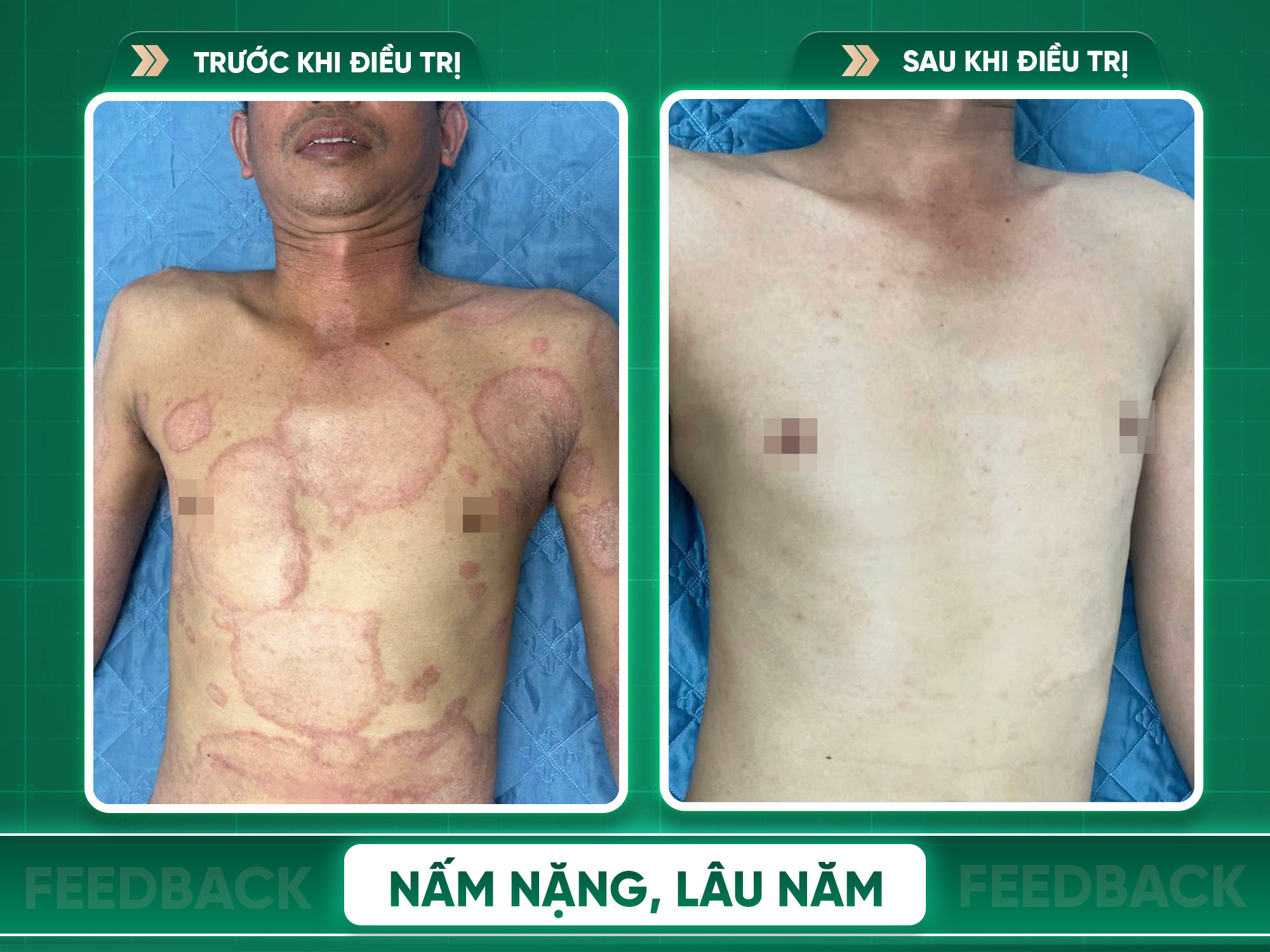 Kết quả trước và sau điều trị nấm da
