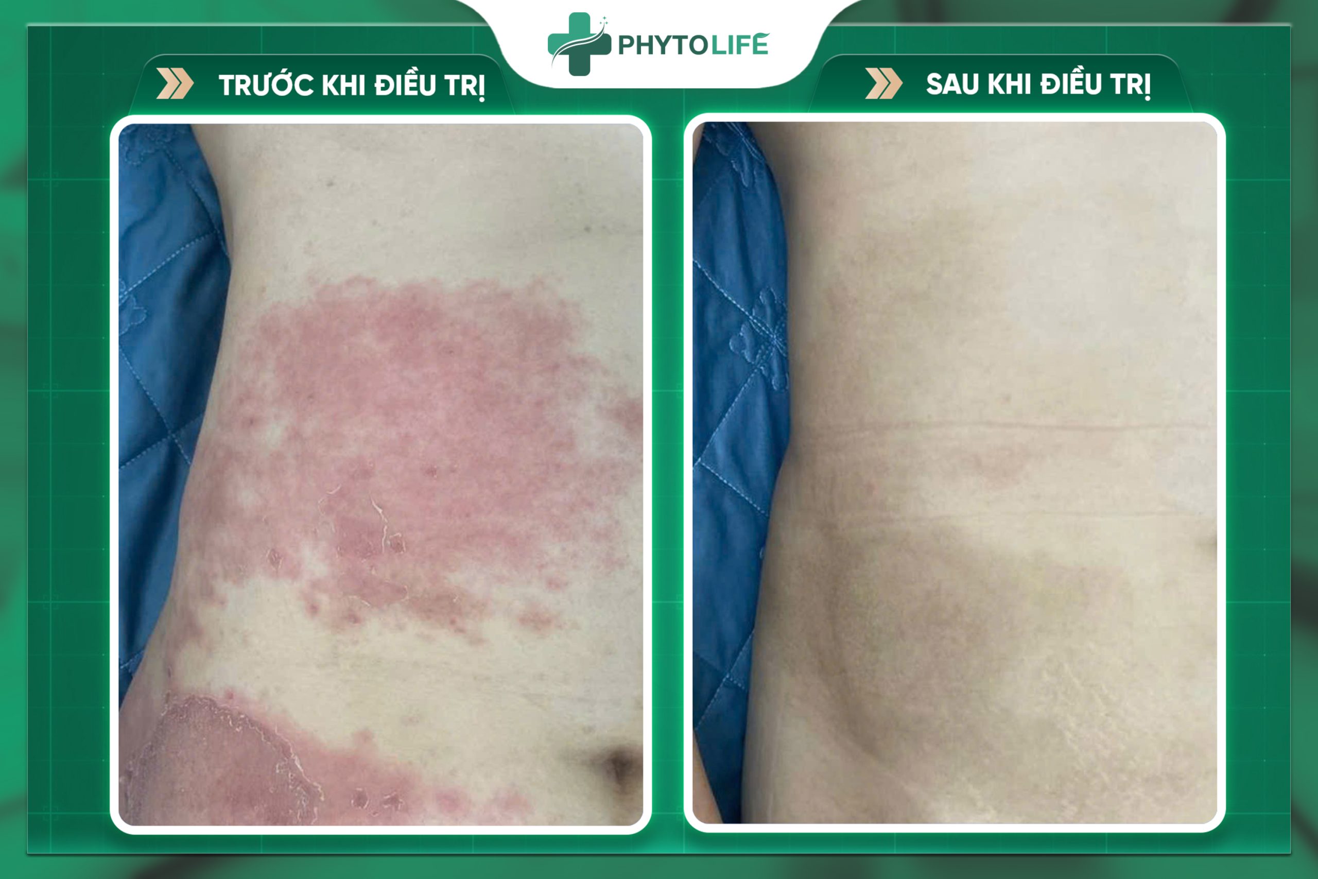 Hình ảnh trước và sau khi điều trị 2