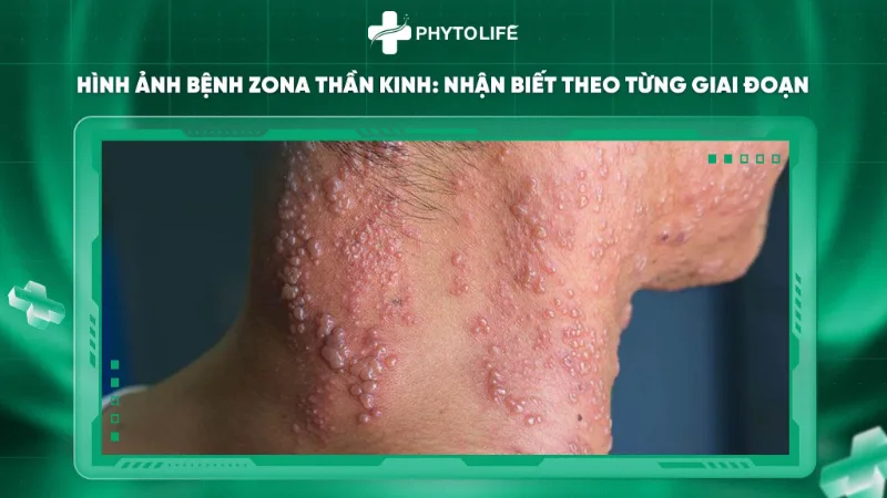 Hình ảnh bệnh zona thần kinh vùng cổ – nhận biết theo từng giai đoạn