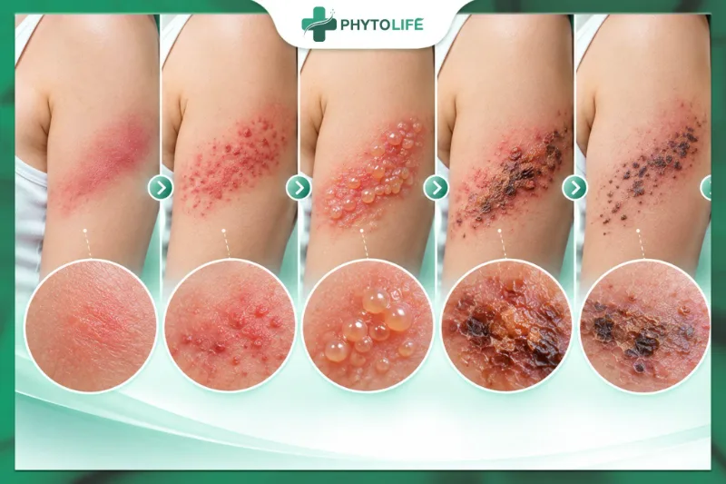 Hình ảnh zona thần kinh qua các giai đoạn phát ban, mụn nước, đóng vảy và hồi phục
