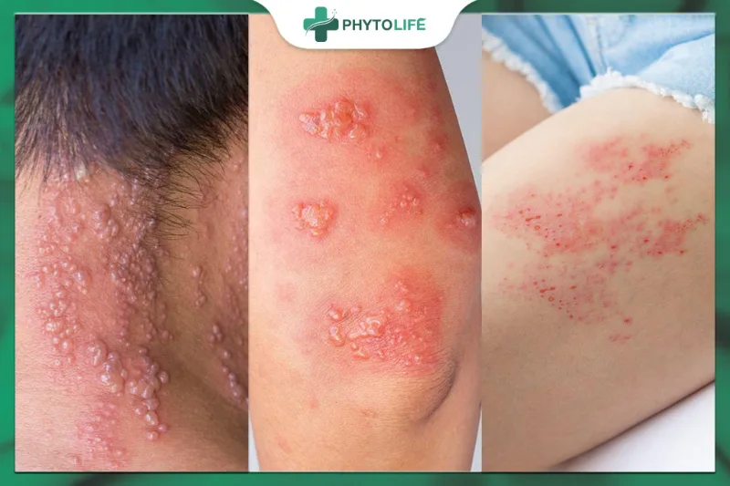 Hình ảnh zona thần kinh ở cổ, lưng và tay
