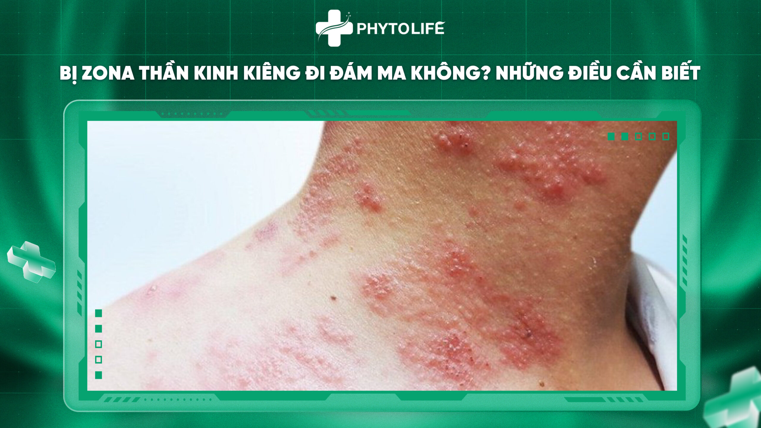 Bị zona thần kinh kiến ​​đi đám ma không? Những điều cần biết